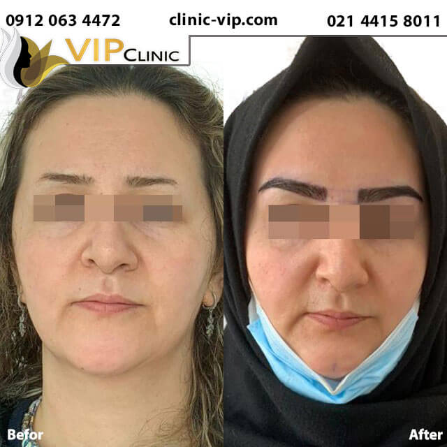عکس نمونه کاشت ابرو برای ابروهایی که ریزش داشته اند