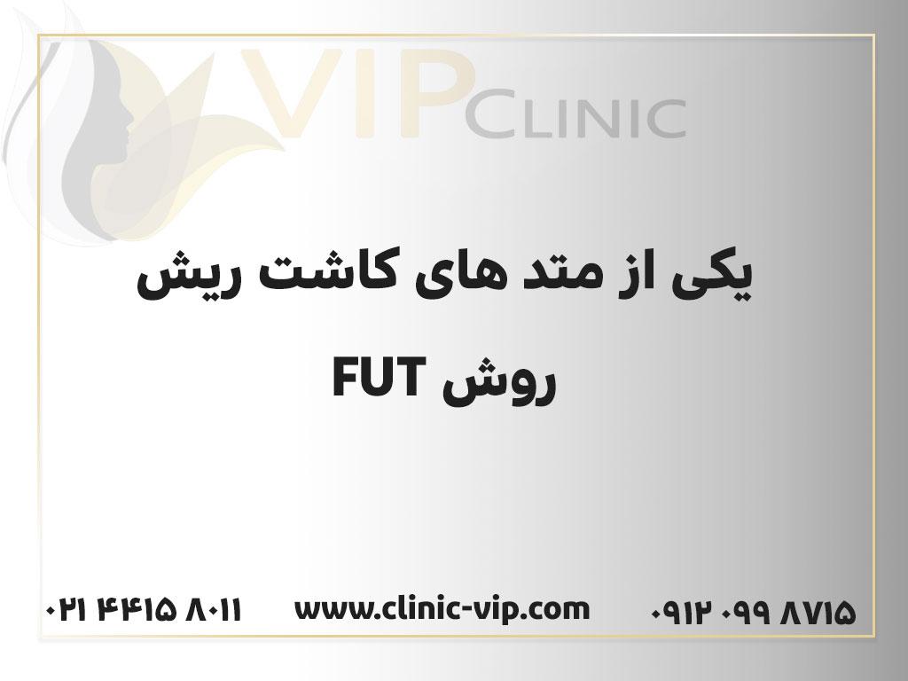 روش کاشت ریش FUT-کلینیک vip