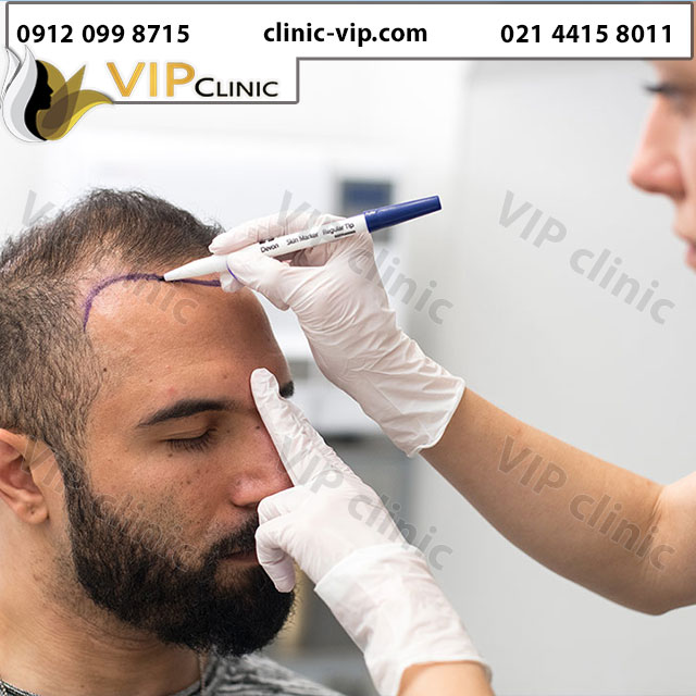 کاشت مو با هیرلاین طبیعی و براساس خط رویش مو