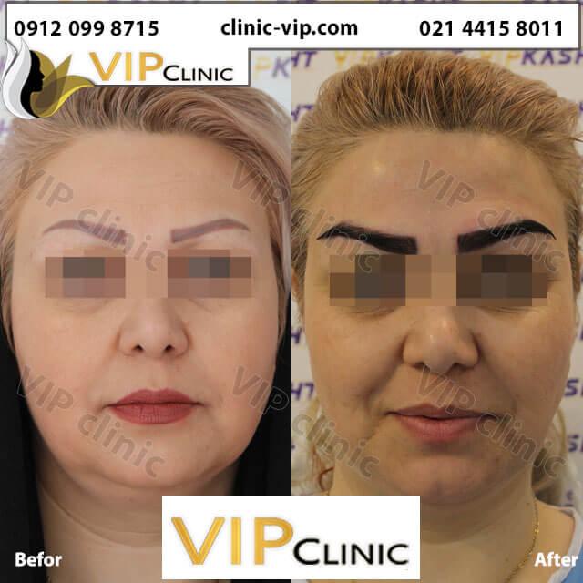 کاشت ابرو حرفه ای در کلینیک کاشت ابرو VIP