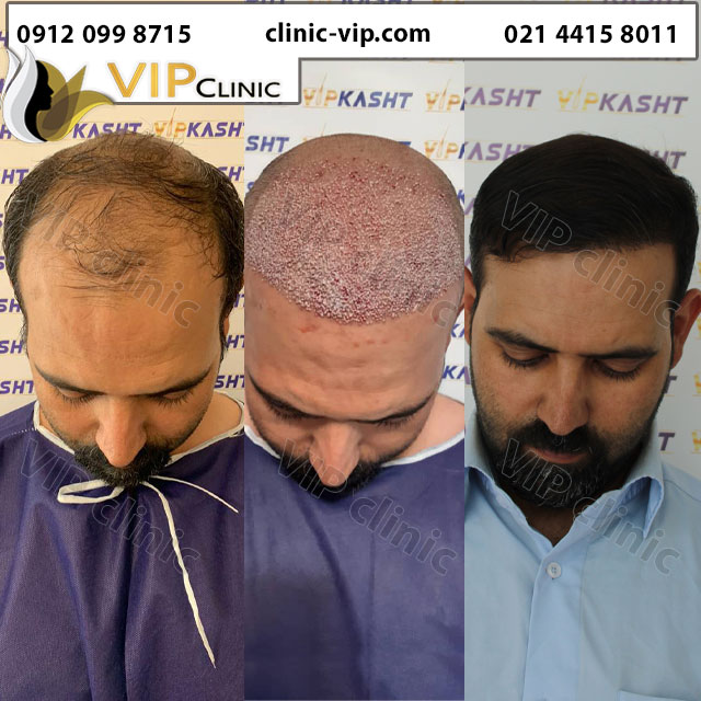 عکس نمونه کاشت مو به روش میکرو sut