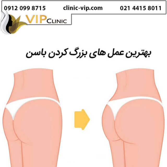 بزرک-کردن-باسن
