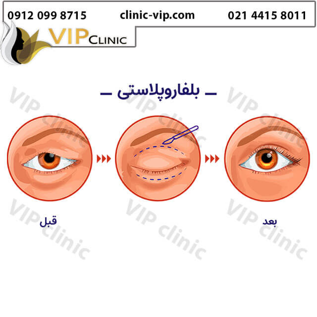 جراحی-پلک-بالا-و-پایین