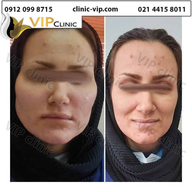 عکس-ورم-بعد-از-تزریق-چربی