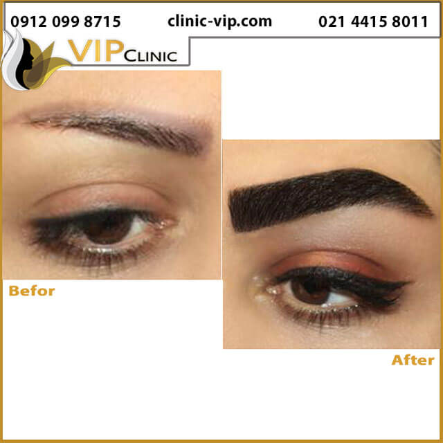 کاشت-ابرو-بعد-از-یکسال