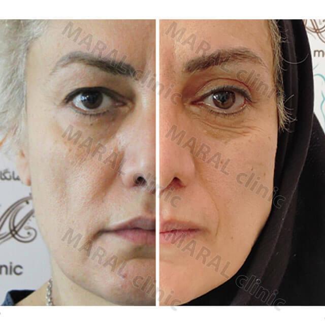 نمونه-افتادگی-پلک