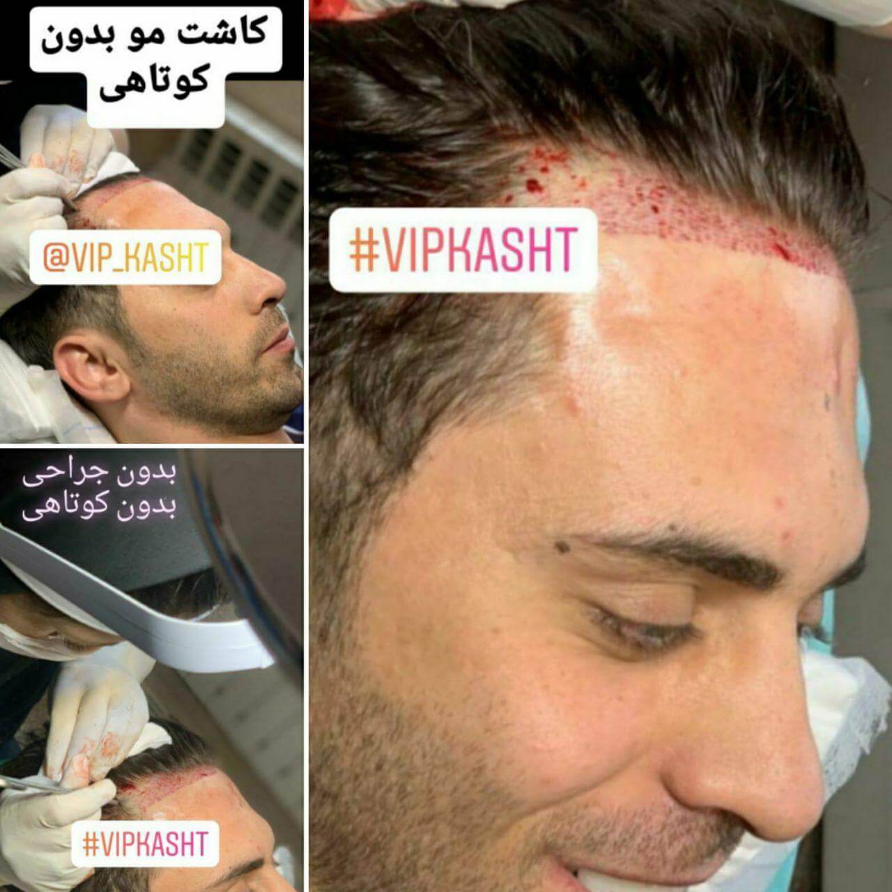 کاشت مو بدون کوتاهی مو کاشت مو بدون کوتاهی