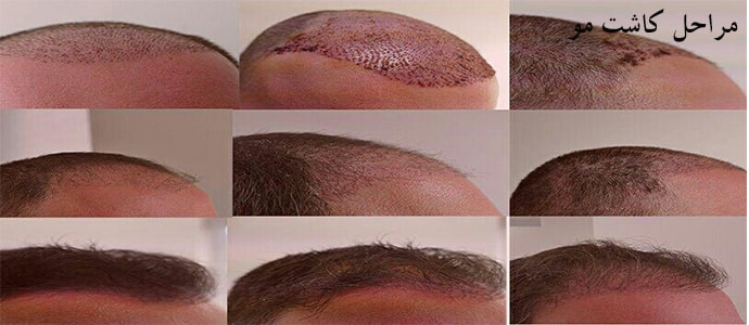 کاشت مو طبیعی در یک جلسه به روش sut