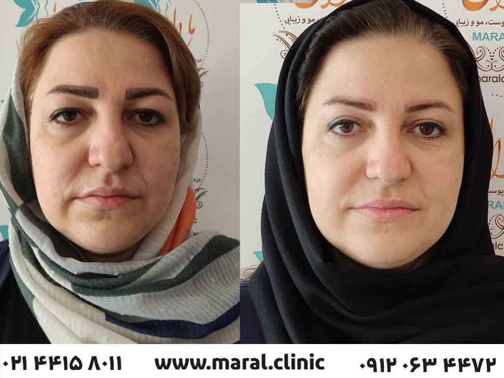 بلفاروپلاستی پلک بالا در تهران کلینیک مجهز مارال