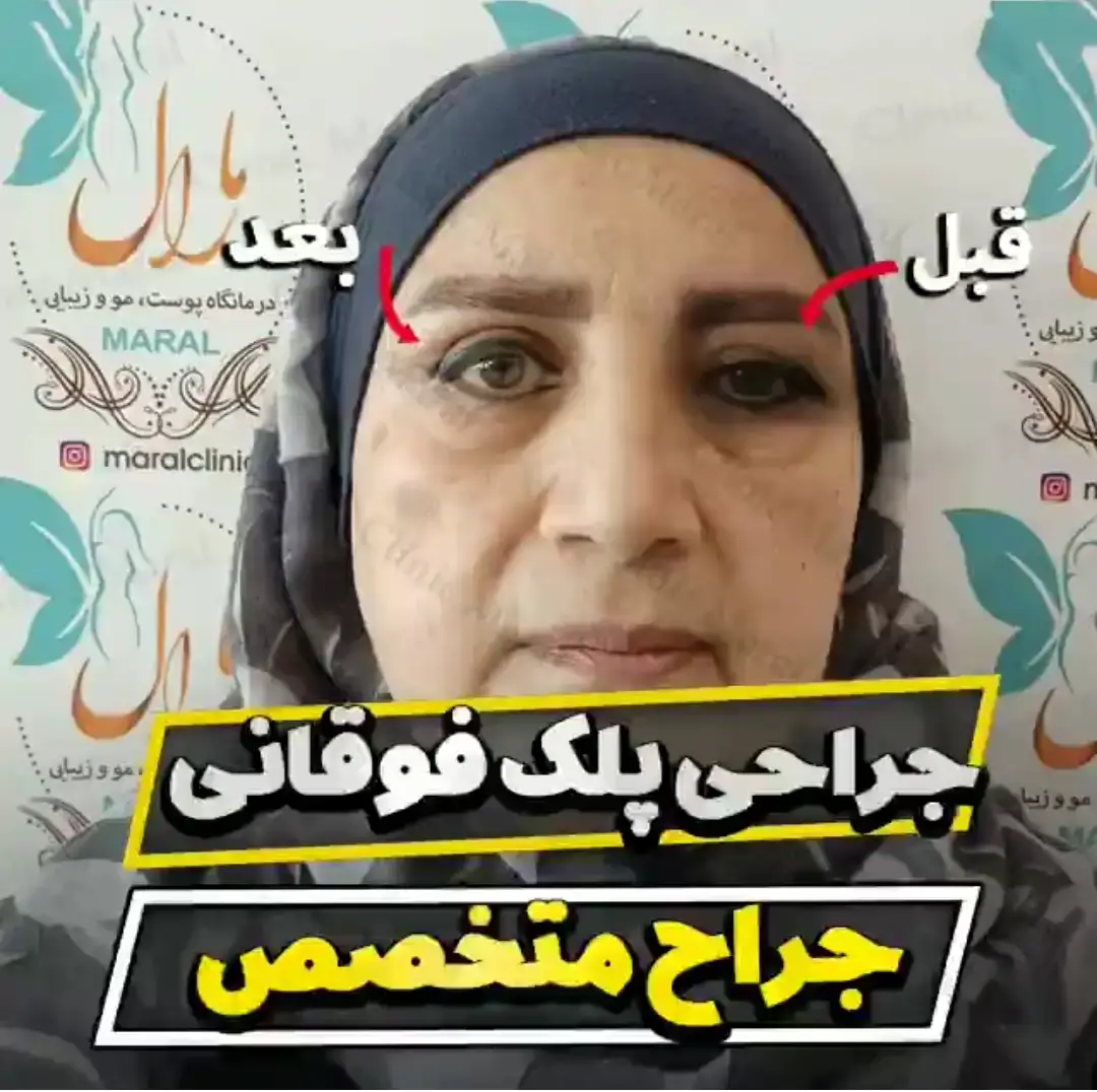 جراحی پلک فوقانی جراح متخصص بلفاروپلاستی تهران