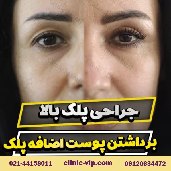 برداشتن پوست اضافه پلک در تهران کلینیک vip
