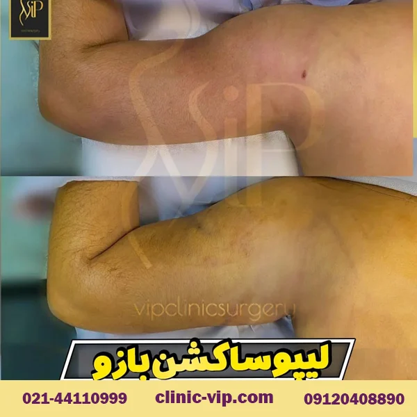 تصاویر قبل و بعد از لیپوساکشن بازو