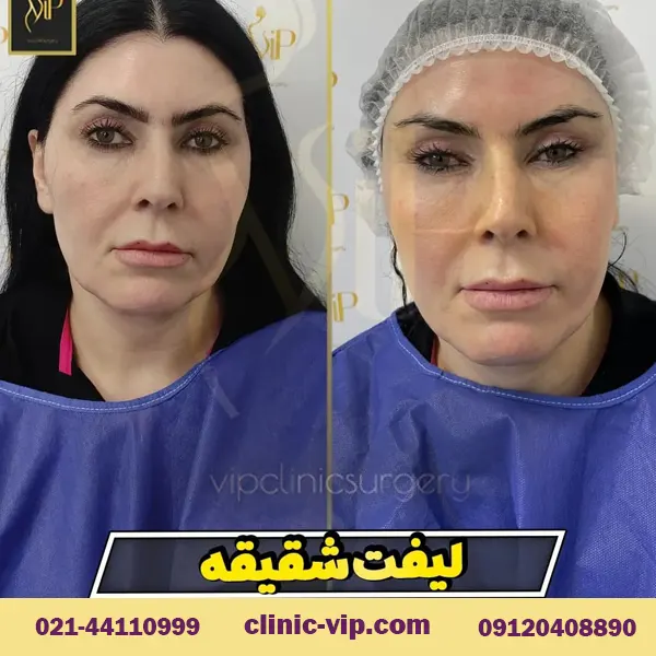 تصاویر قبل و بعد از لیفت شقیقه توسط متخصص جراحی زیبایی