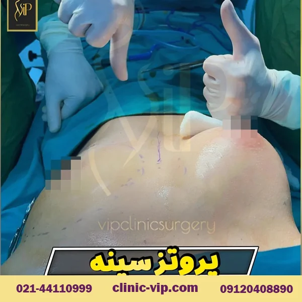 عکس قبل و بعد از پروتز سینه در تهران کلینیک vip
