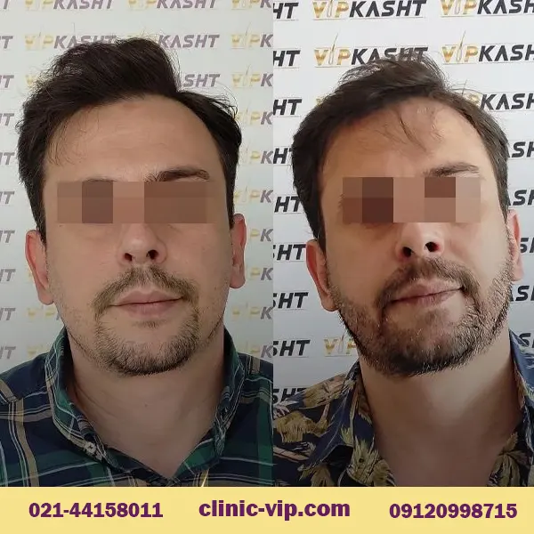 قبل و بعد از کاشت ریش در کلینیک وی آی پی