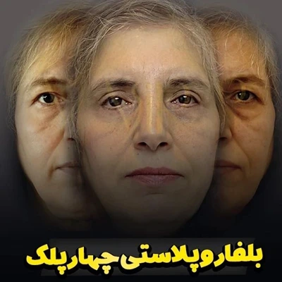 نتیجه بلفاروپلاستی