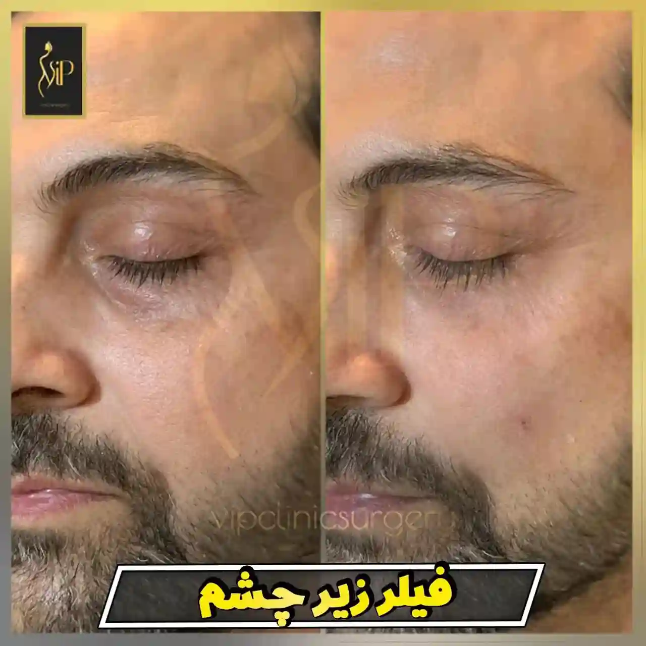 فیلر زیر چشمفیلر زیر چشم