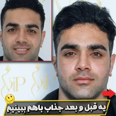 جناب اقای مرادی قبل و بعد از عمل پلک
