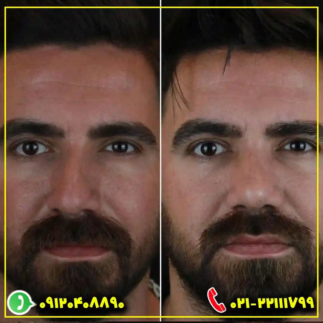 عکس قبل و بعد بینی