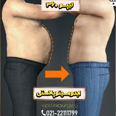 عکس قبل و بعد از لیپوماتیک شکم و پهلو