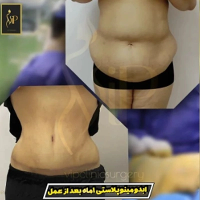 عکی قبل و بعد از لیپوماتیک شکم و پهلو در کلینیک vip