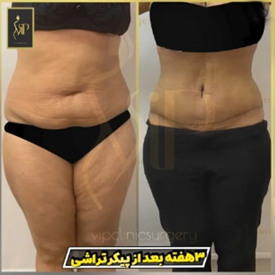 عکس قبل و بعد از لیپوماتیک شکم