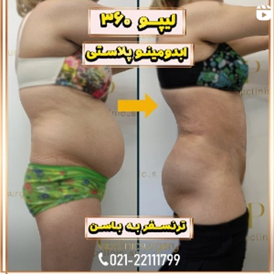 عکس قبل و بعد از عمل ابدومینوپلاستی توسط متخصص جراحی زیبایی و ترمیمی