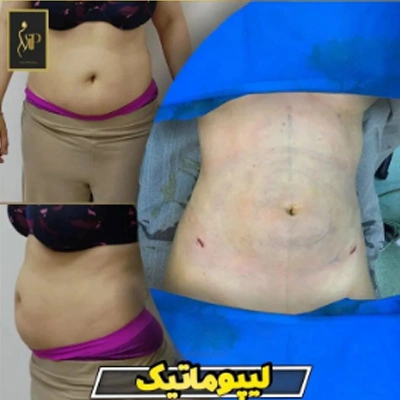 عکس قبل و بعد از ساکشن شکم
