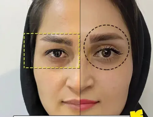 بهترین متخصص جراحی زیبایی پلک در ایران کیست؟