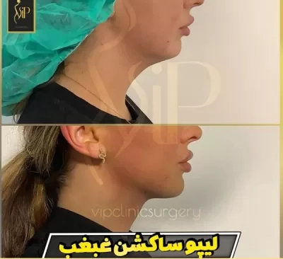 لیپوساکشن غبغب خانم محمدی توسط متخصص جراحی زیبایی در کلینیک Vip