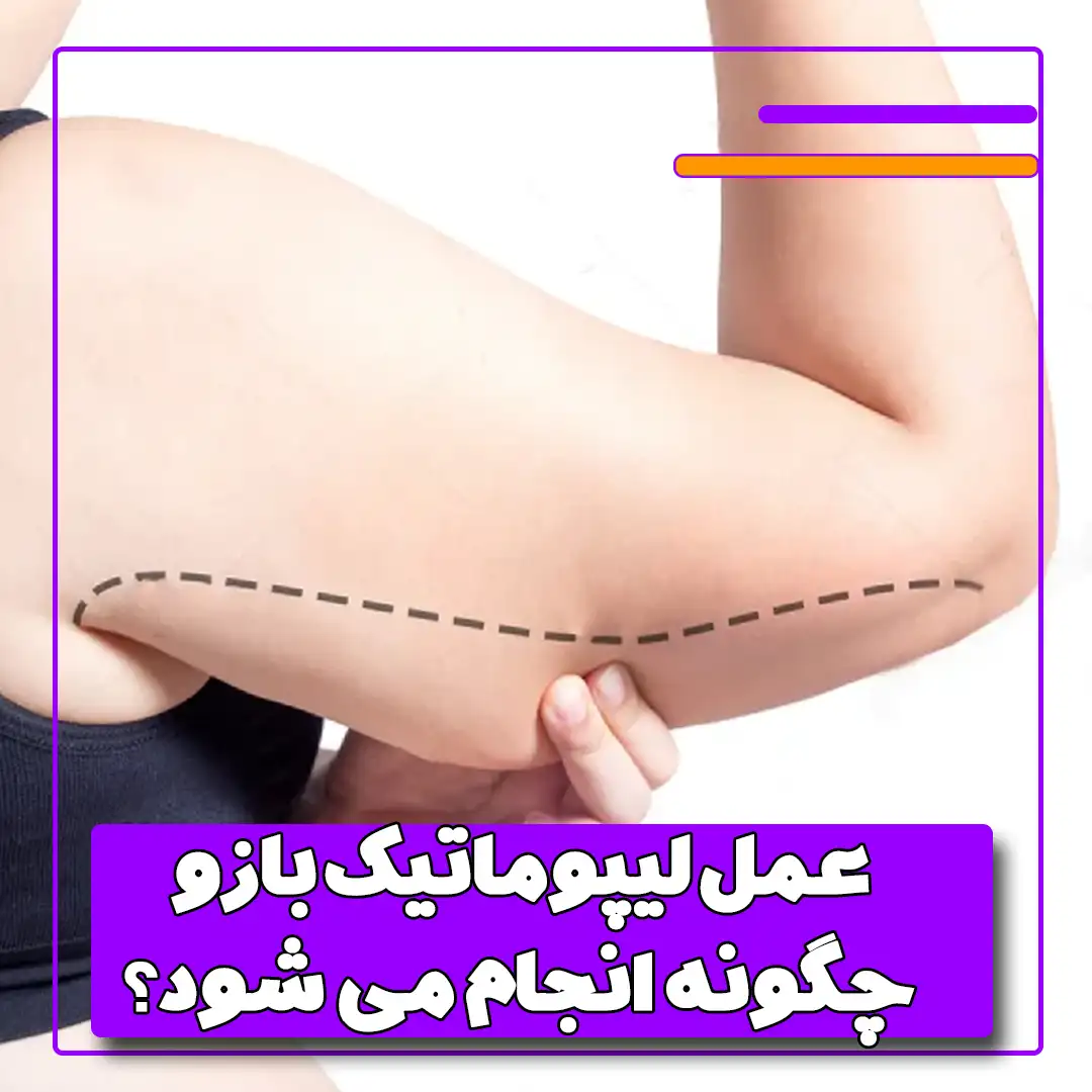 عمل لیپوماتیک بازو چگونه انجام می شود؟ 