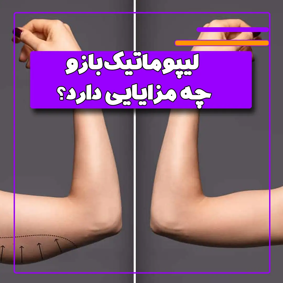 لیپوماتیک بازو چه مزایایی دارد؟