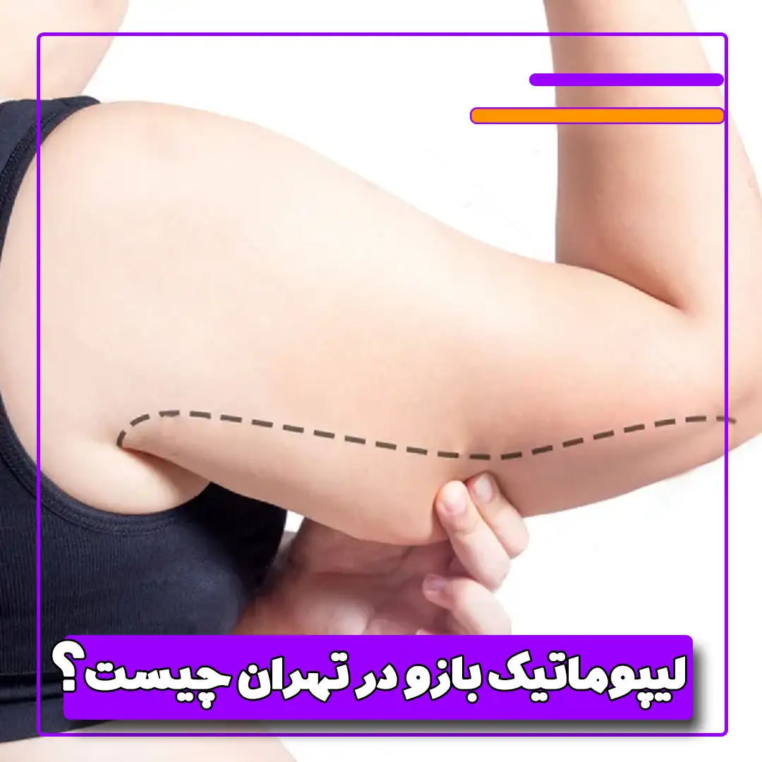 لیپوماتیک بازو در تهران چیست؟
