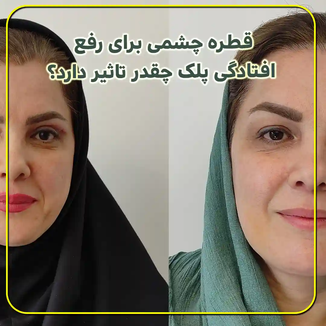 قطره چشمی برای رفع افتادگی پلک