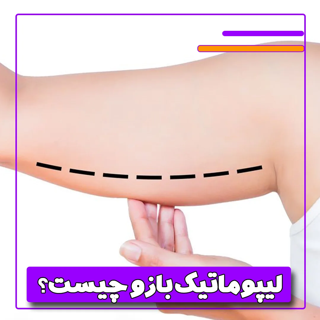 لیپوماتیک بازو چیست؟