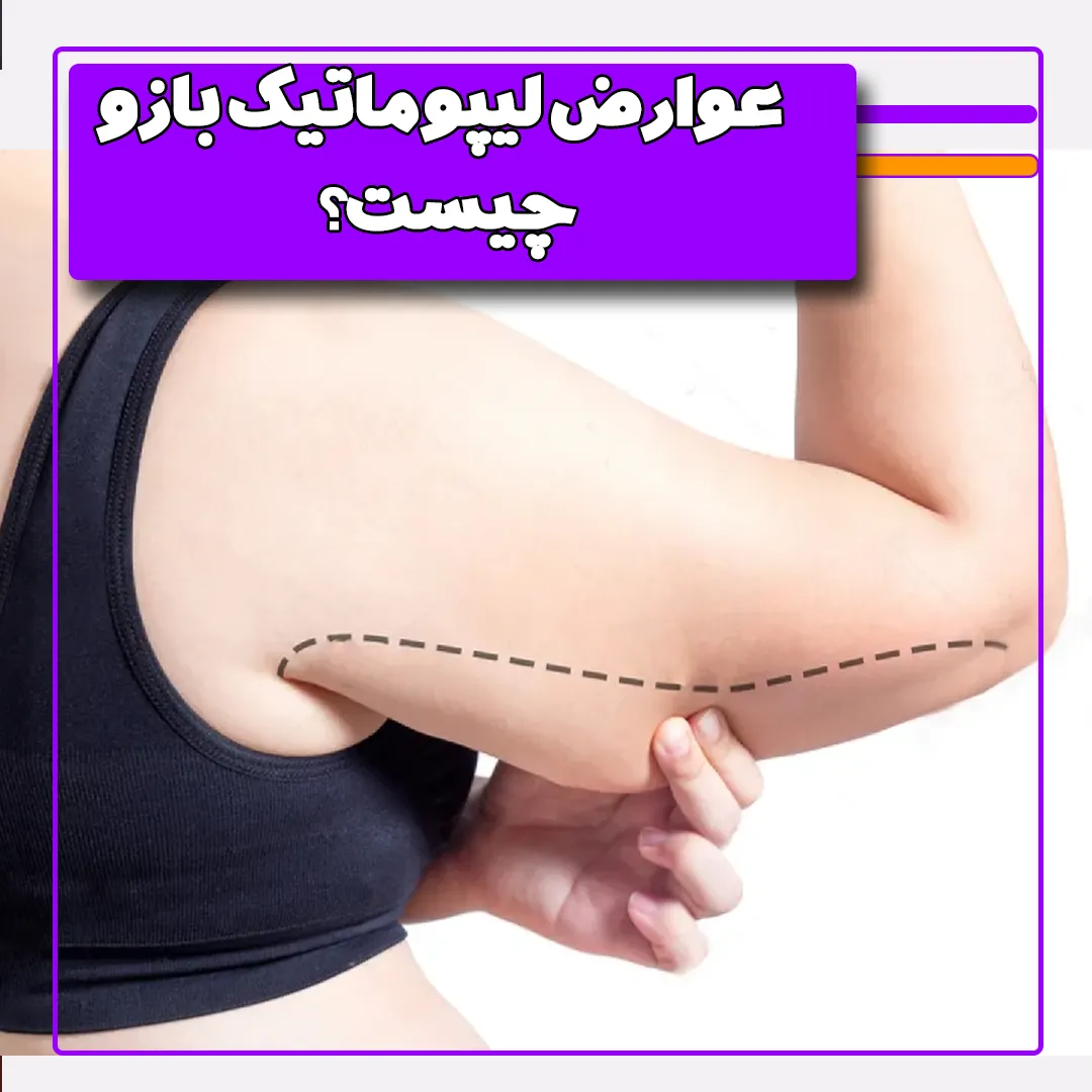 عوارض لیپوماتیک بازو چیست؟
