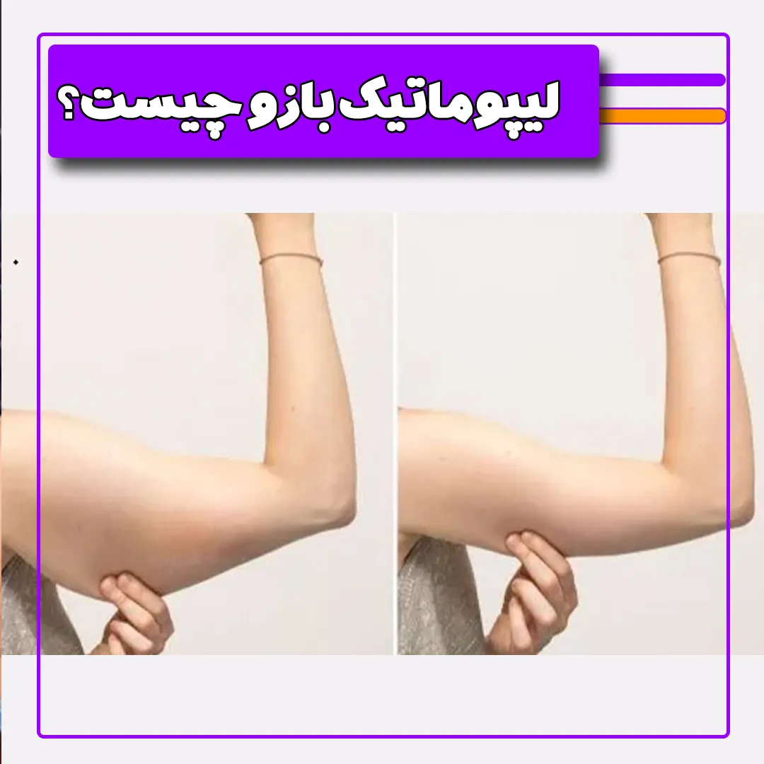لیپوماتیک بازو چیست؟