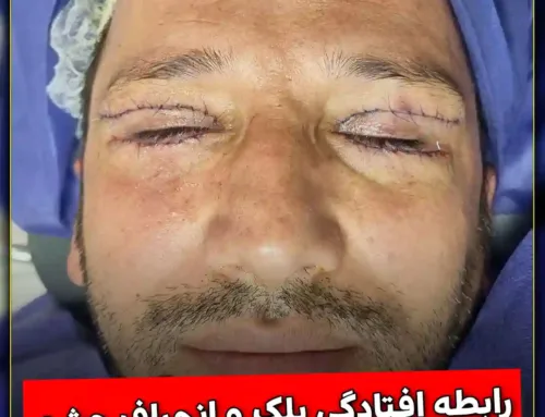 رابطه افتادگی پلک و انحراف چشم